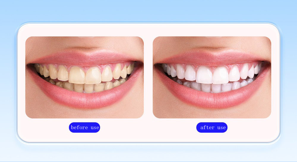 Teeth Whitening