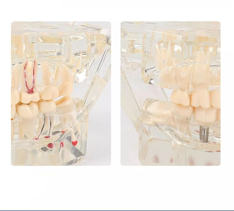 Dental model of teeth